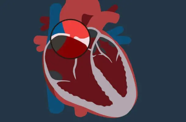 Kalp Deliği Ameliyatı Nasıl Yapılır?